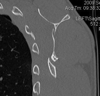 Scapular Body Fracture CT